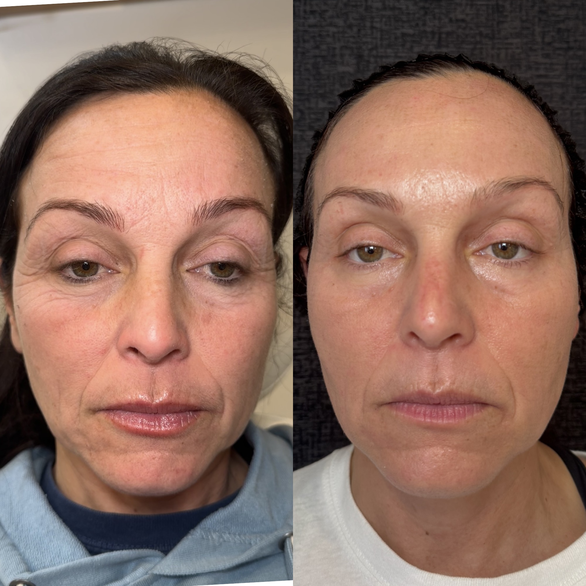 CO2 Laser Skin Resurfacing (VeloPeel) treatment at Eternal Beauty Lifestyle Clearwater Spa, Clearwater FL — VeloPeel — our light, superficial fractional CO2 laser — fades sun spots, softens fine lines and wrinkles, and resurfaces skin for a smoother, brighter glow. Full face $700 • neck $450 • hands $350 • 3-session packages from $900. CO2 scar treatment from $250.