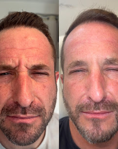Botox & Daxxify in Clearwater FL