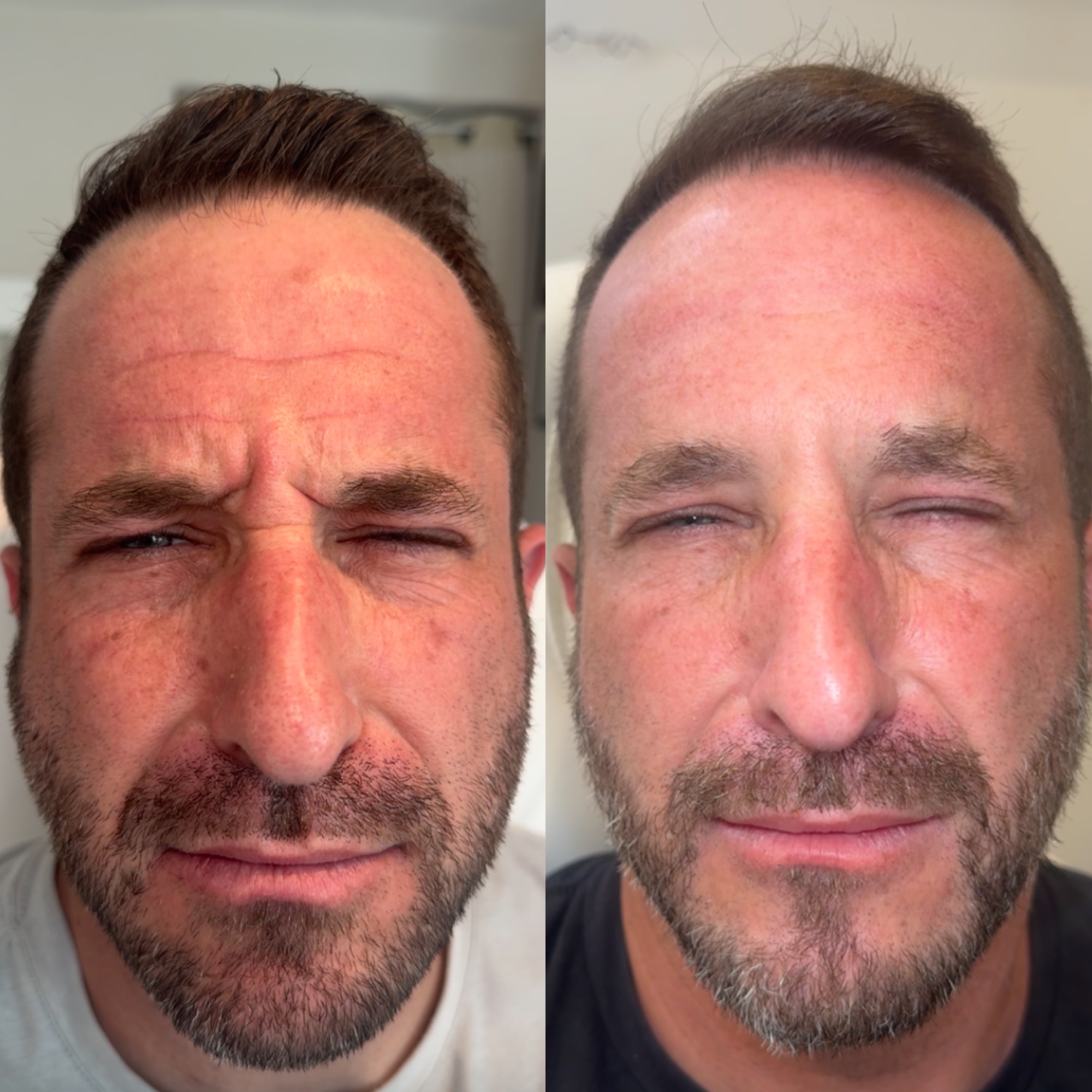 Botox & Daxxify for Redington Beach FL patients