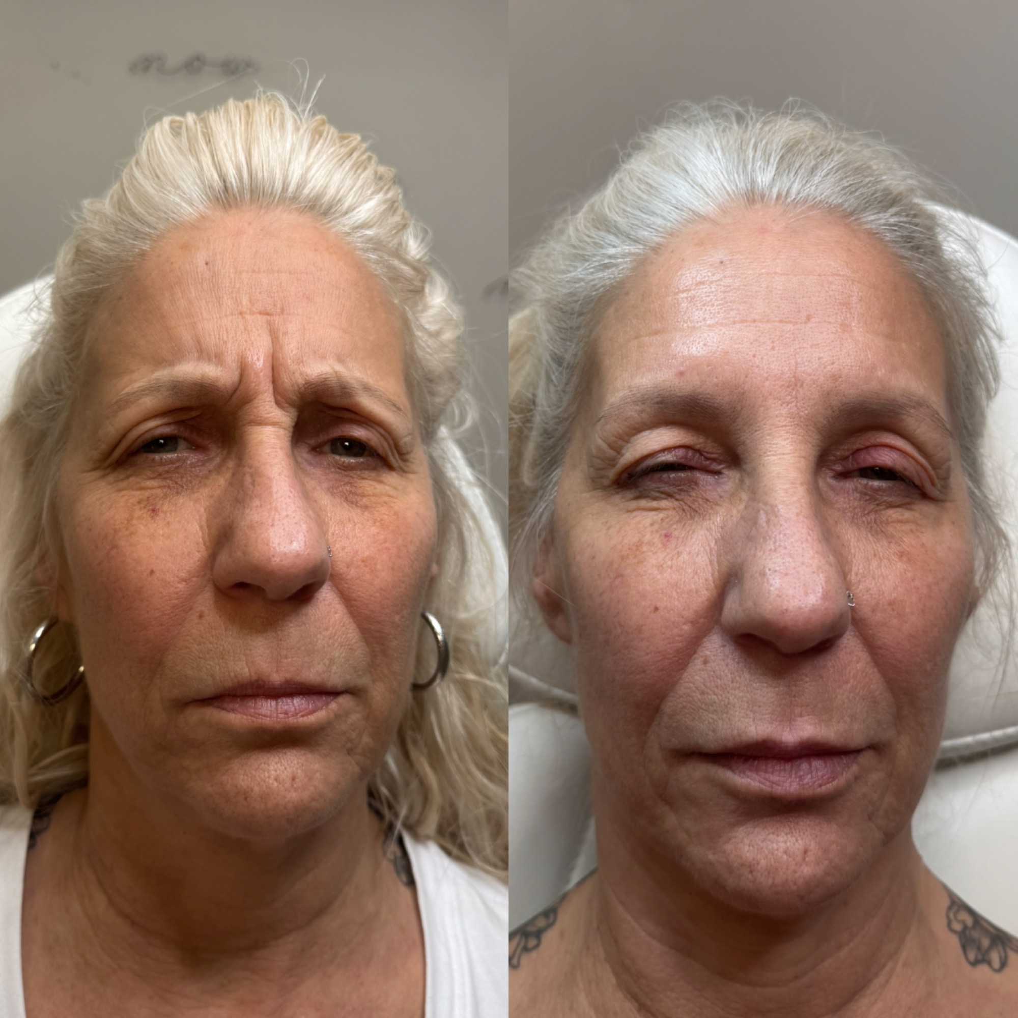 Daxxify — Botox Alternative treatment at Eternal Beauty Lifestyle Clearwater Spa, Clearwater FL — Smooth fine lines and refresh your natural features with expertly placed neuromodulator treatments — subtle, never frozen.