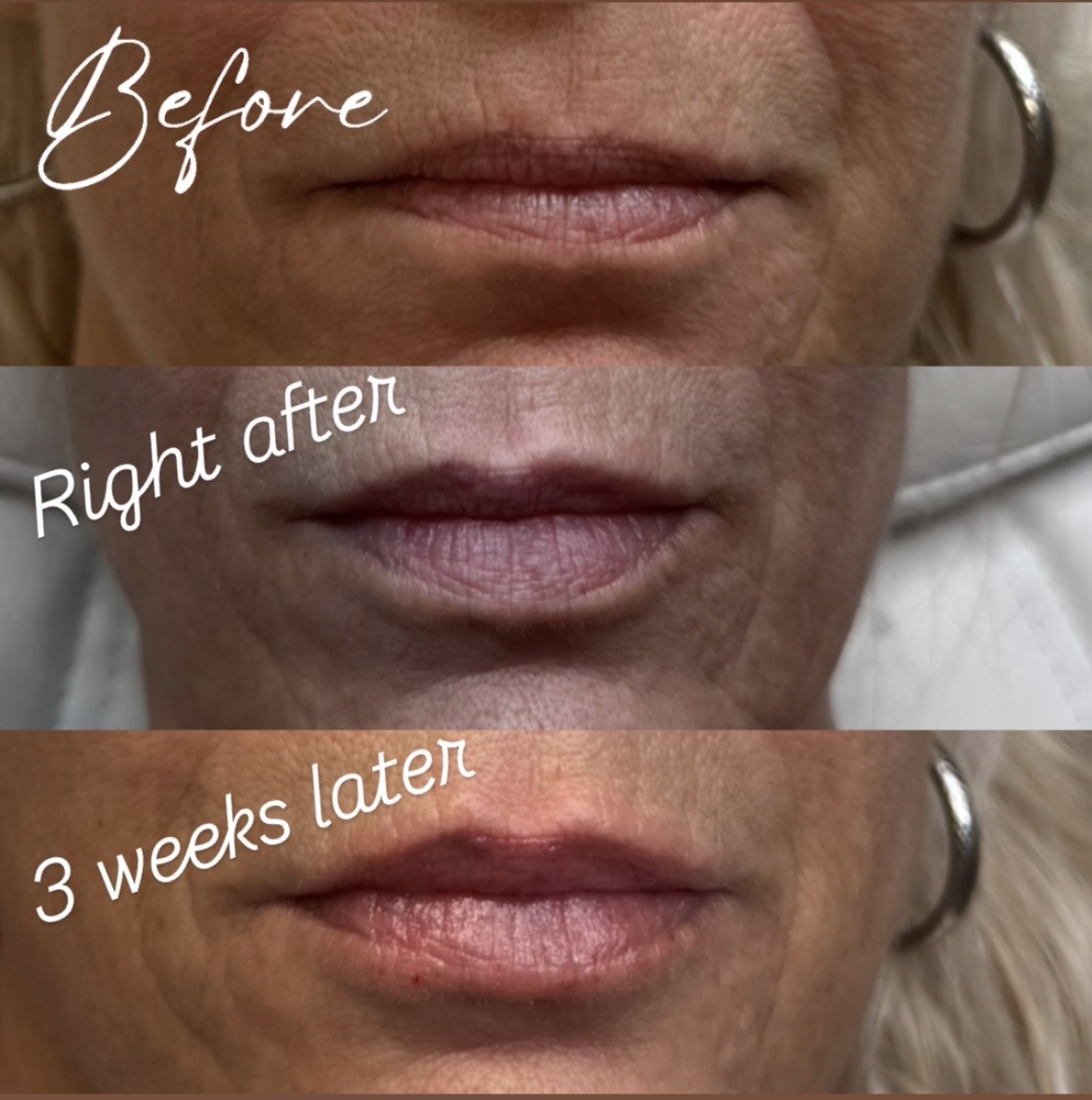 Lip Fillers & Facial Contouring for Redington Beach FL patients