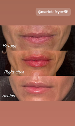 Lip Fillers & Facial Contouring in Clearwater FL